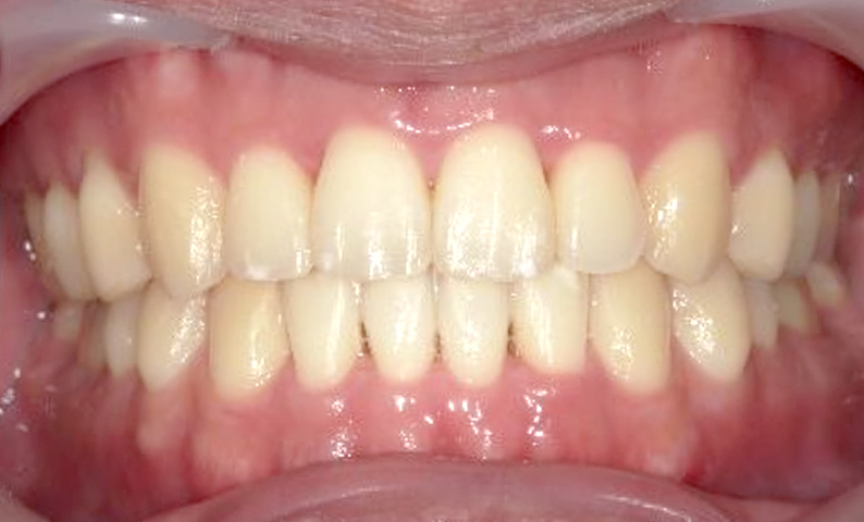部分矯正すきっ歯の症例写真