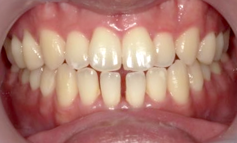 部分矯正すきっ歯の症例写真
