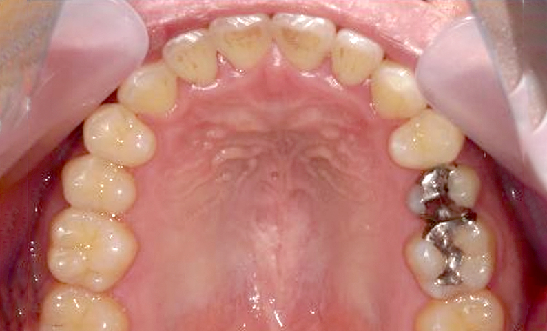 部分矯正すきっ歯の症例写真