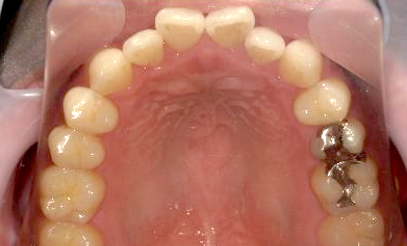 部分矯正すきっ歯の症例写真