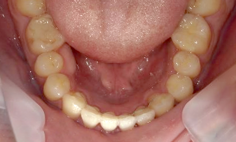 部分矯正すきっ歯の症例写真