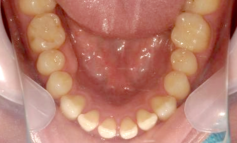 部分矯正すきっ歯の症例写真