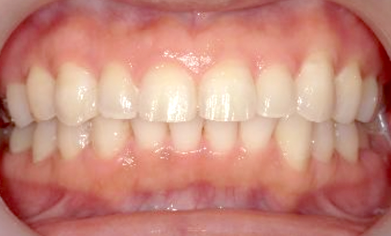 部分矯正 すきっ歯の症例写真