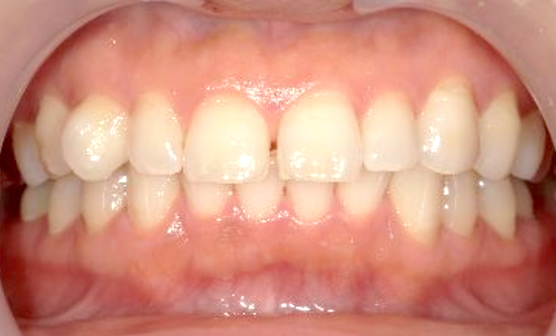 部分矯正 すきっ歯の症例写真