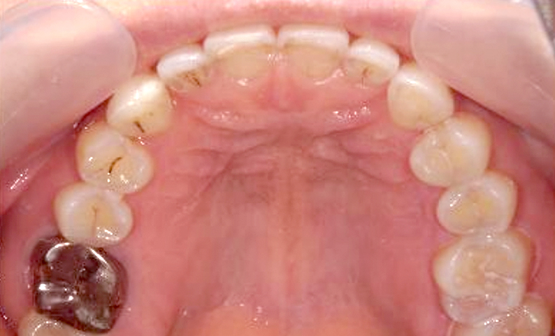 部分矯正 すきっ歯の症例写真