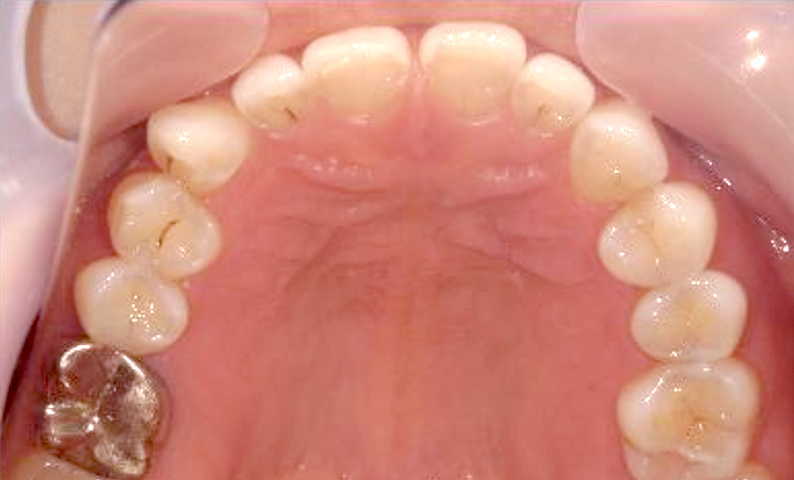 部分矯正 すきっ歯の症例写真