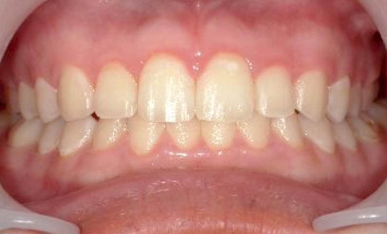 部分矯正 すきっ歯の症例写真