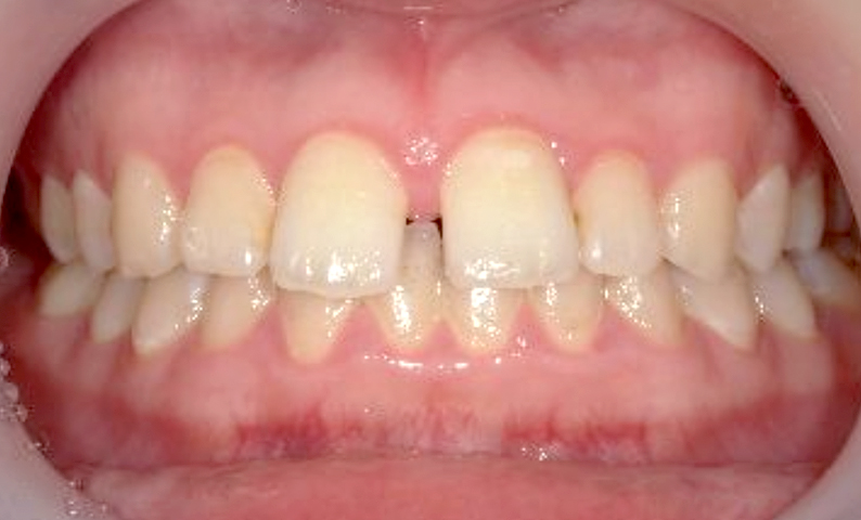 部分矯正 すきっ歯の症例写真