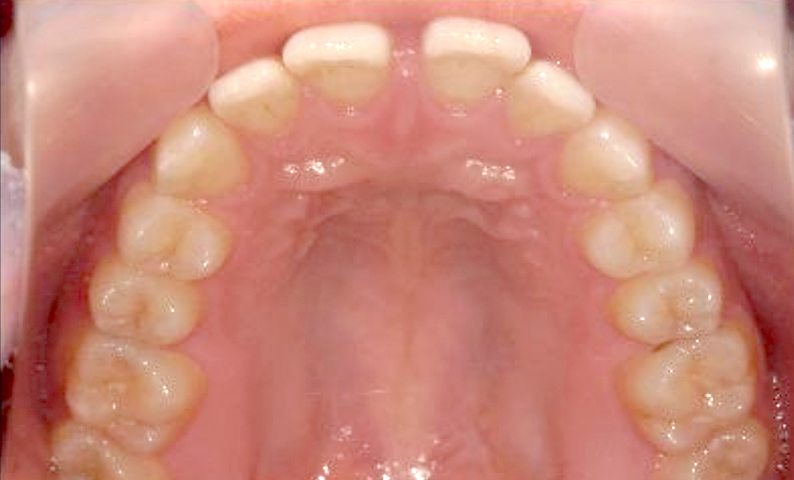 部分矯正 すきっ歯の症例写真