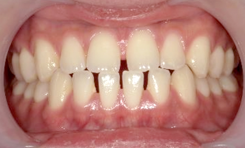 部分矯正すきっ歯の症例写真