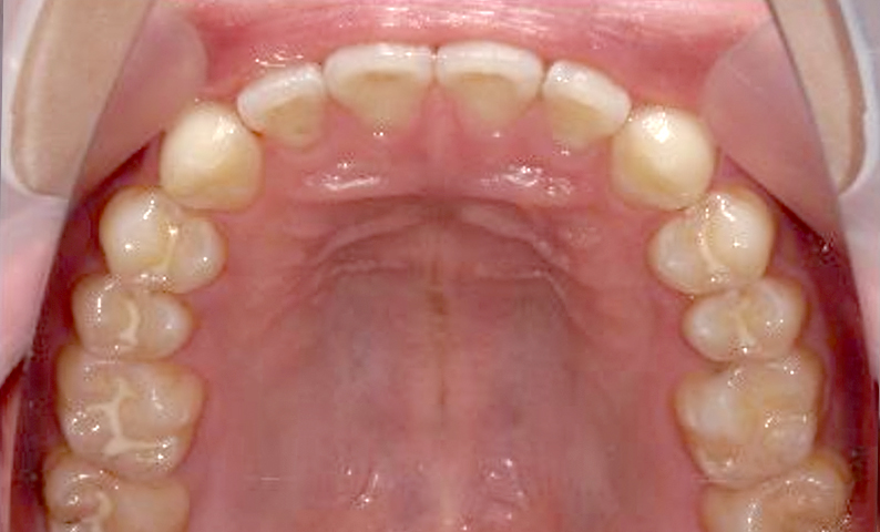 部分矯正すきっ歯の症例写真