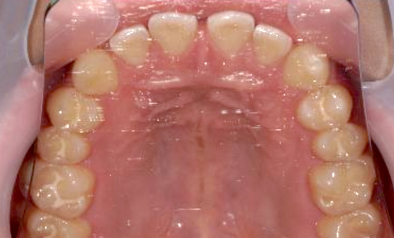 部分矯正すきっ歯の症例写真