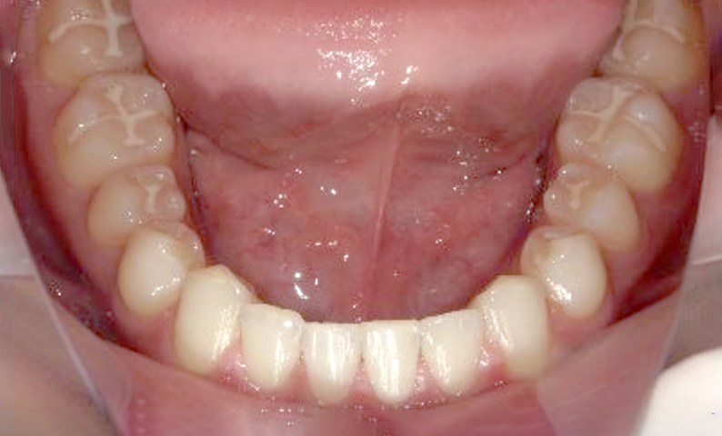 部分矯正すきっ歯の症例写真