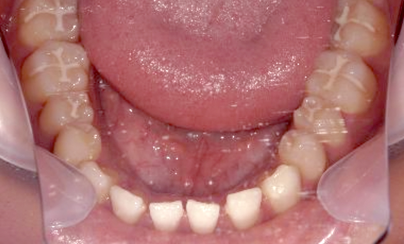 部分矯正すきっ歯の症例写真