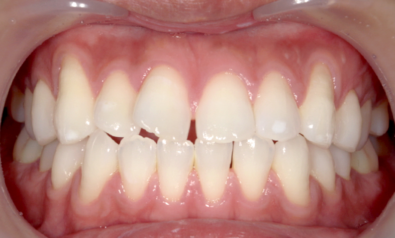 部分矯正 すきっ歯の症例写真