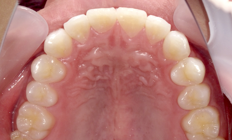 部分矯正 すきっ歯の症例写真