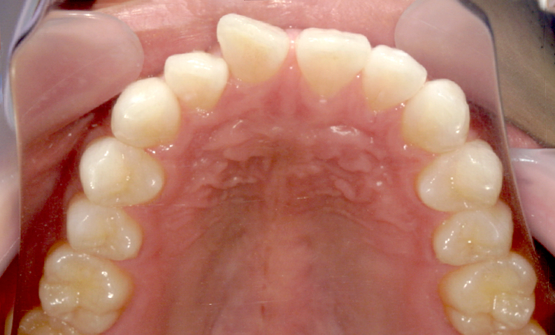 部分矯正 すきっ歯の症例写真