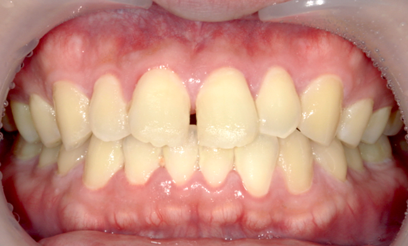 部分矯正 すきっ歯の症例写真
