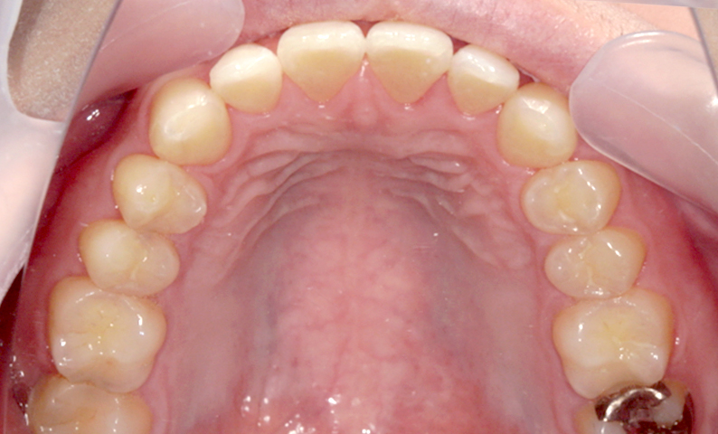 部分矯正 すきっ歯の症例写真