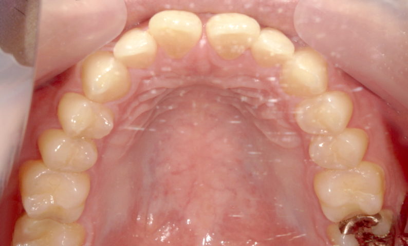 部分矯正 すきっ歯の症例写真