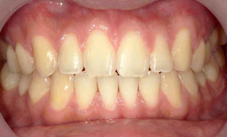 部分矯正 すきっ歯の症例写真