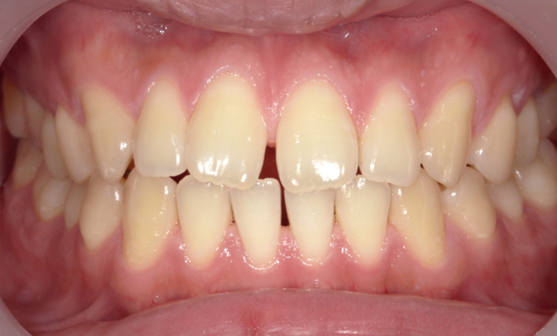 部分矯正 すきっ歯の症例写真