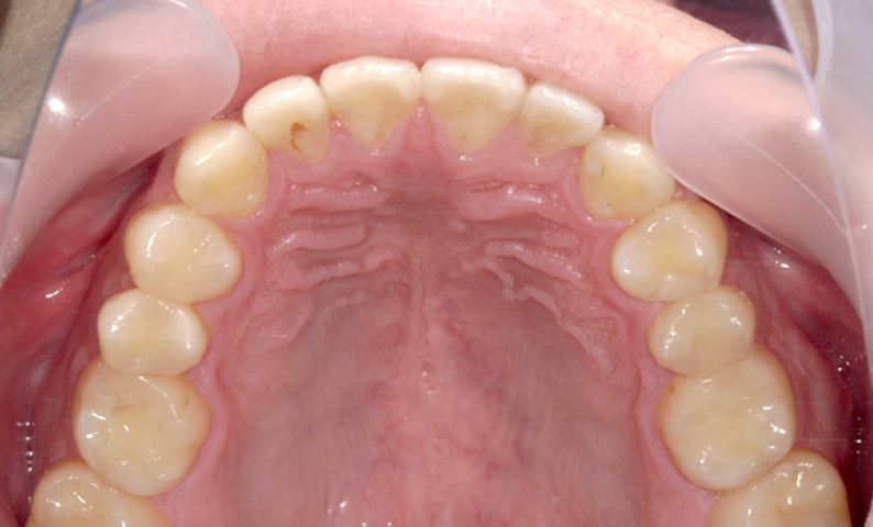 部分矯正 すきっ歯の症例写真