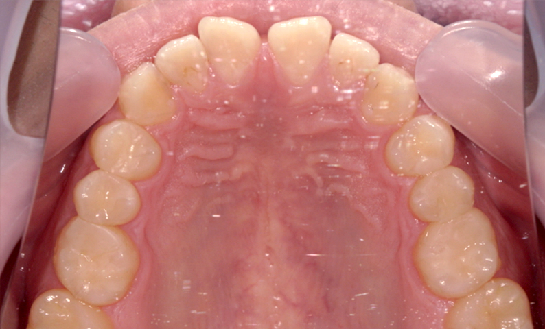 部分矯正 すきっ歯の症例写真