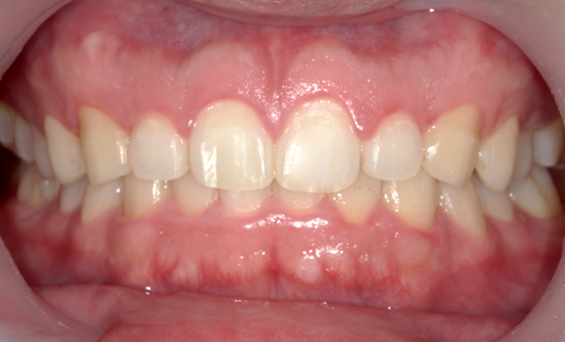 部分矯正 すきっ歯の症例写真