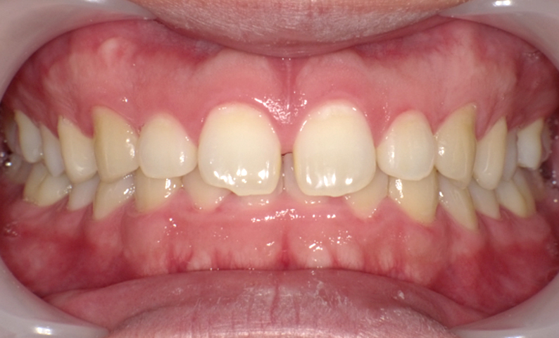 部分矯正 すきっ歯の症例写真