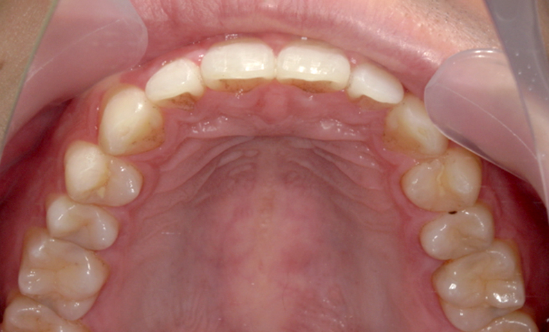 部分矯正 すきっ歯の症例写真