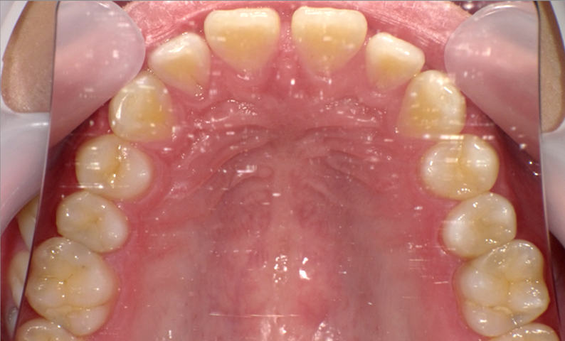 部分矯正 すきっ歯の症例写真