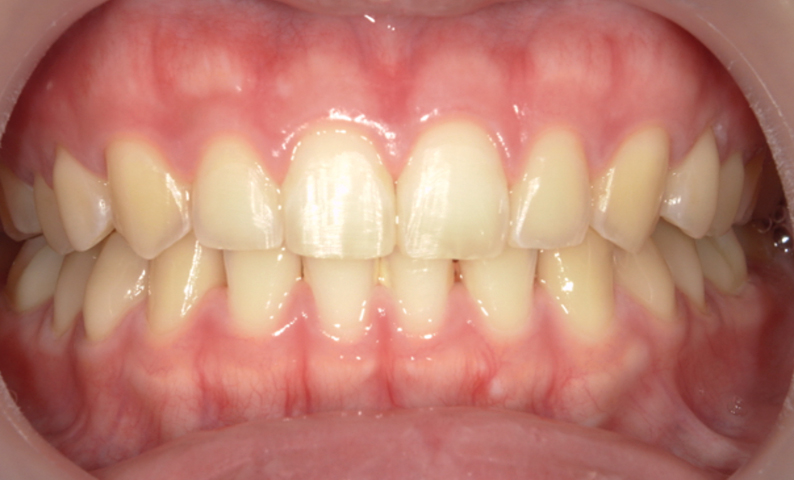 部分矯正 すきっ歯の症例写真