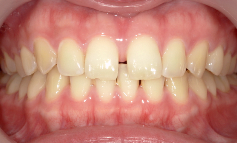 部分矯正 すきっ歯の症例写真