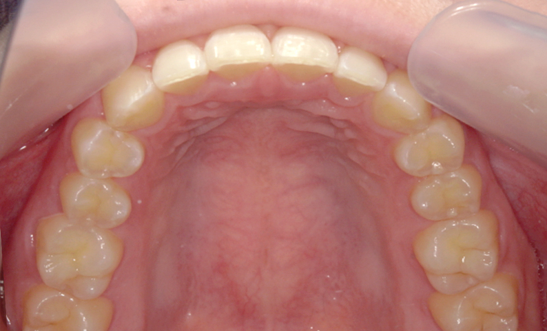 部分矯正 すきっ歯の症例写真