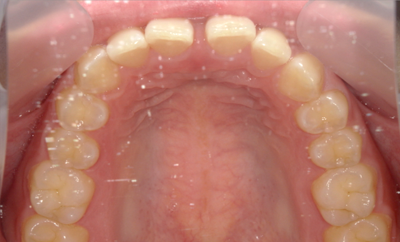 部分矯正 すきっ歯の症例写真