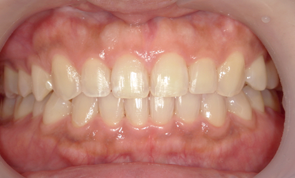 部分矯正すきっ歯の症例写真