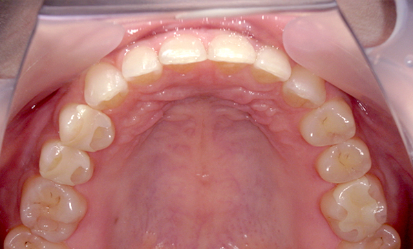 部分矯正すきっ歯の症例写真