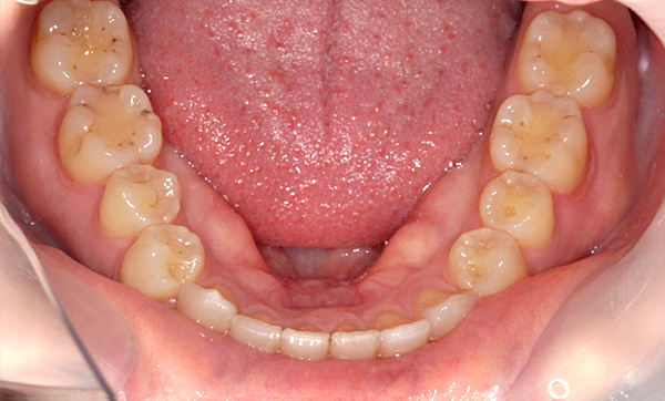 部分矯正すきっ歯の症例写真