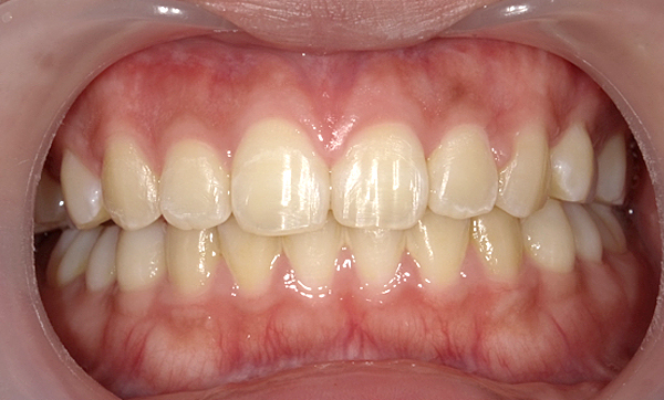 部分矯正 すきっ歯の症例写真