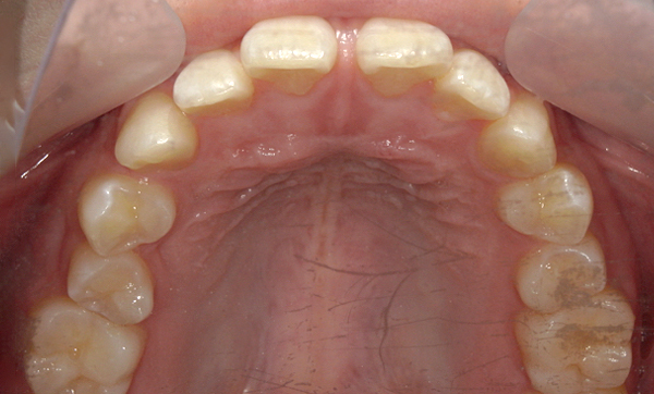 部分矯正 すきっ歯の症例写真