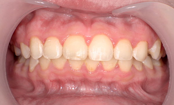 部分矯正 すきっ歯の症例写真