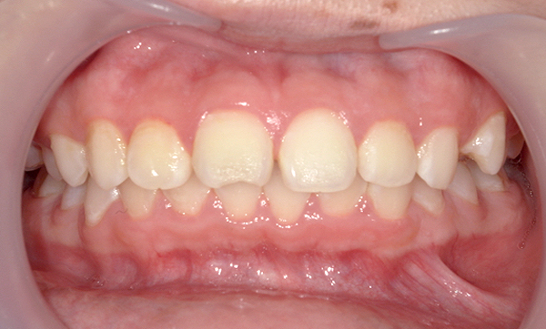 部分矯正 すきっ歯の症例写真