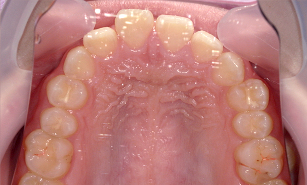 部分矯正 すきっ歯の症例写真