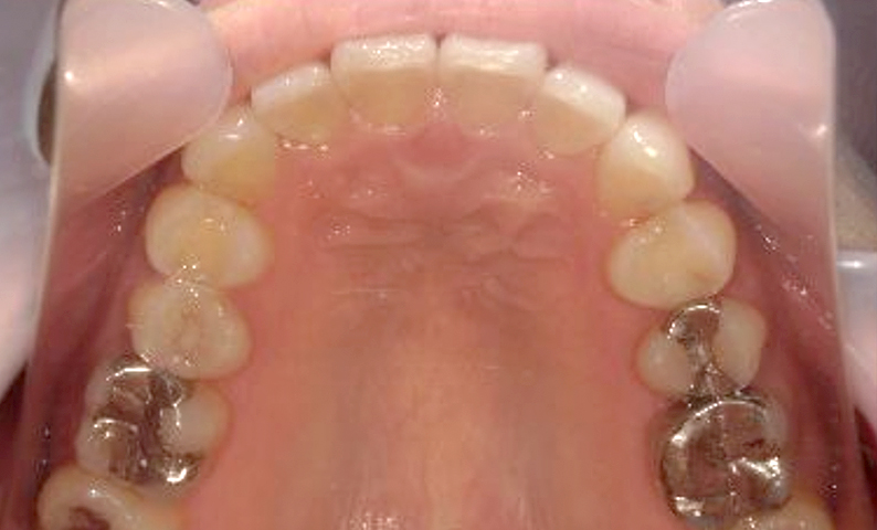 部分矯正 上の部分矯正の症例写真