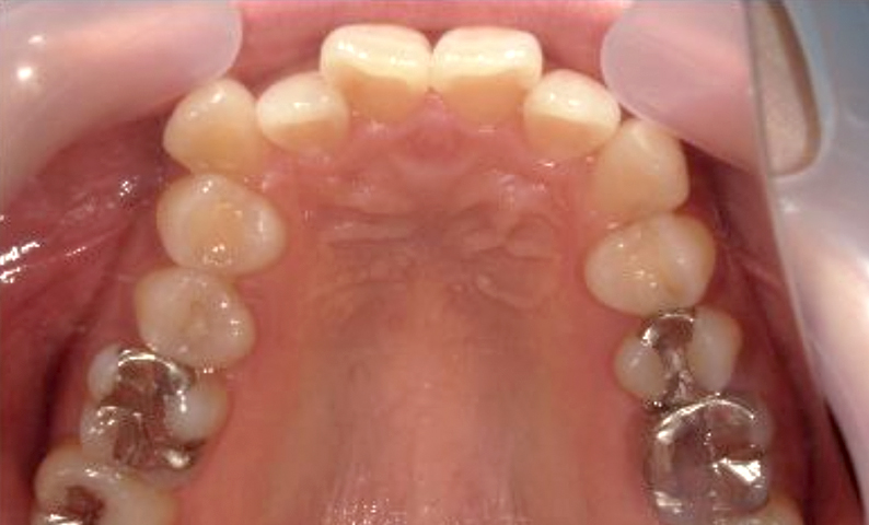 部分矯正 上の部分矯正の症例写真