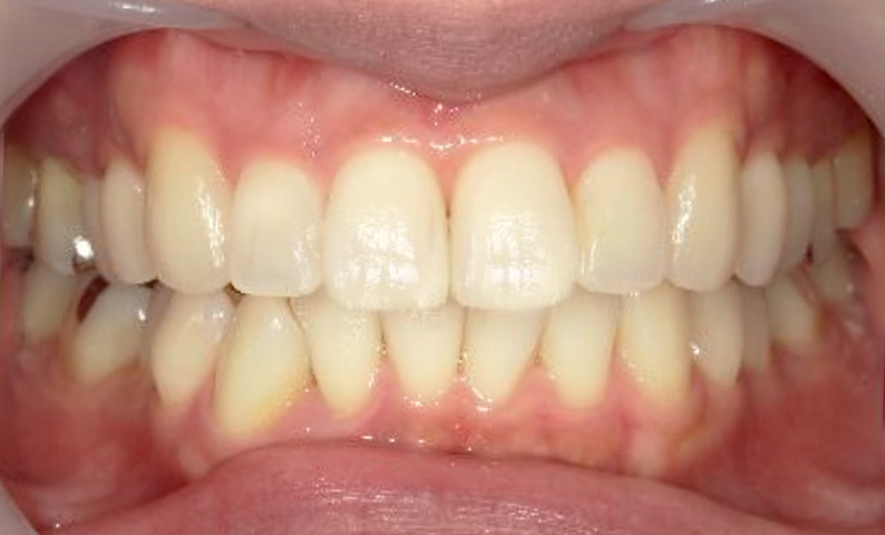 部分矯正 上の部分矯正の症例写真