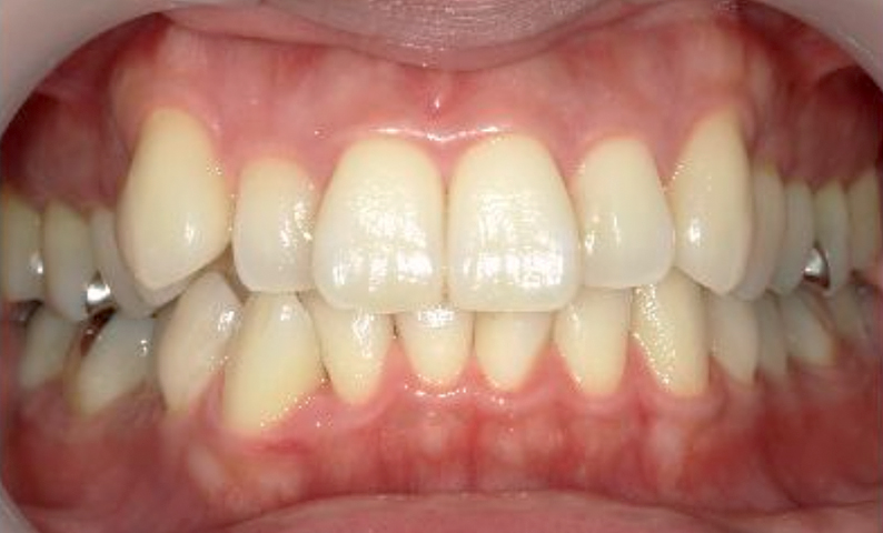 部分矯正 上の部分矯正の症例写真