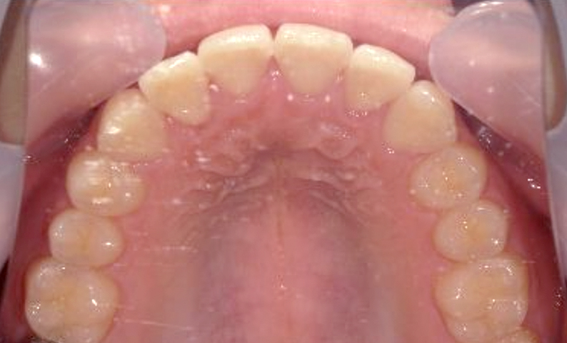 部分矯正 上の部分矯正の症例写真