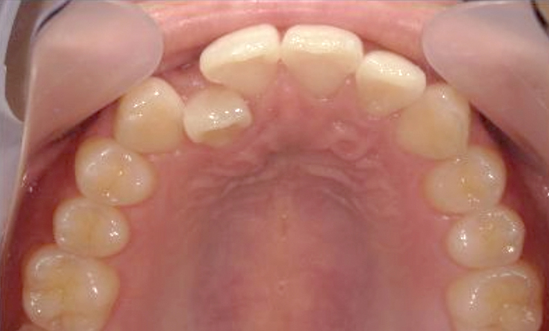 部分矯正 上の部分矯正の症例写真